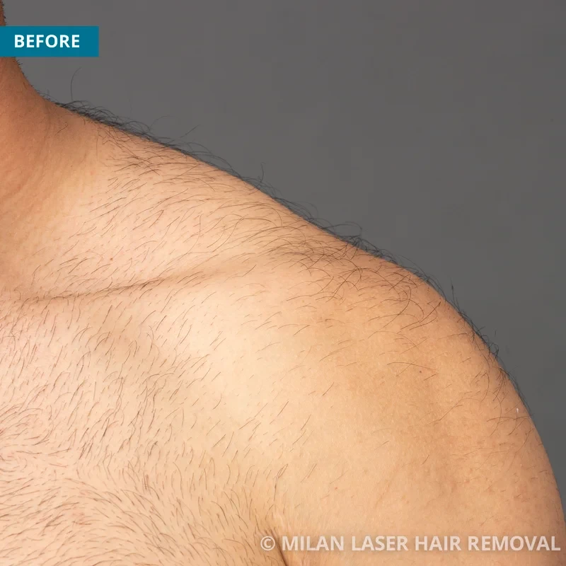 Before photo of a men prior to getting our men laser hair removal treatment
