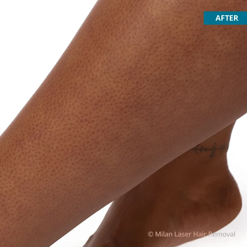 After photo of a legs after getting our legs laser hair removal treatment