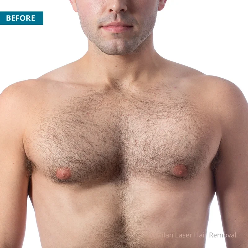 Before photo of a men prior to getting our men laser hair removal treatment