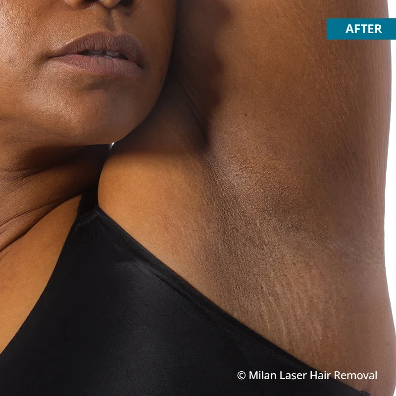 After photo of a underarm after getting our underarm laser hair removal treatment