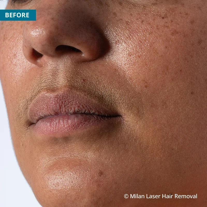 Before photo of a lip prior to getting our lip laser hair removal treatment