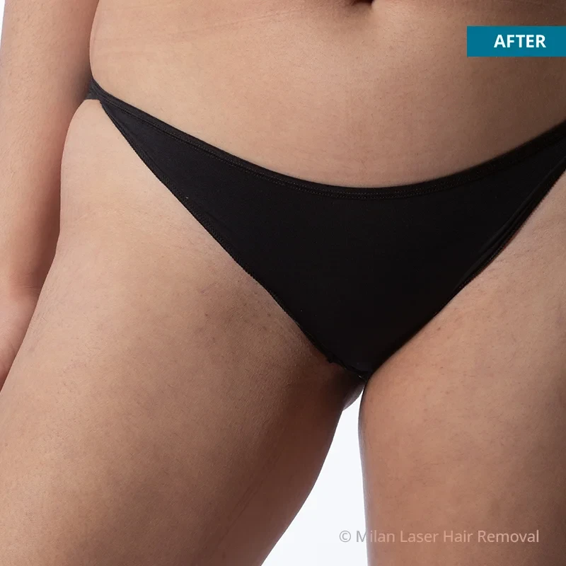 After photo of a bikini after getting our bikini laser hair removal treatment