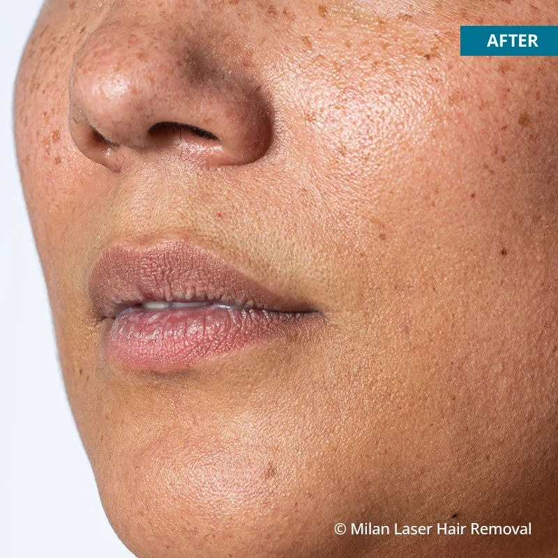 After photo of a lip after getting our lip laser hair removal treatment