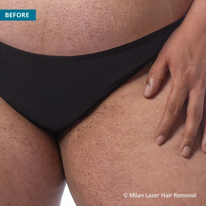 Before photo of a bikini prior to getting our bikini laser hair removal treatment