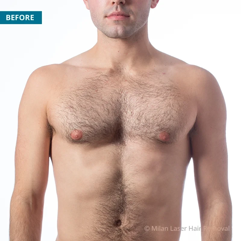 Before photo of a men prior to getting our men laser hair removal treatment