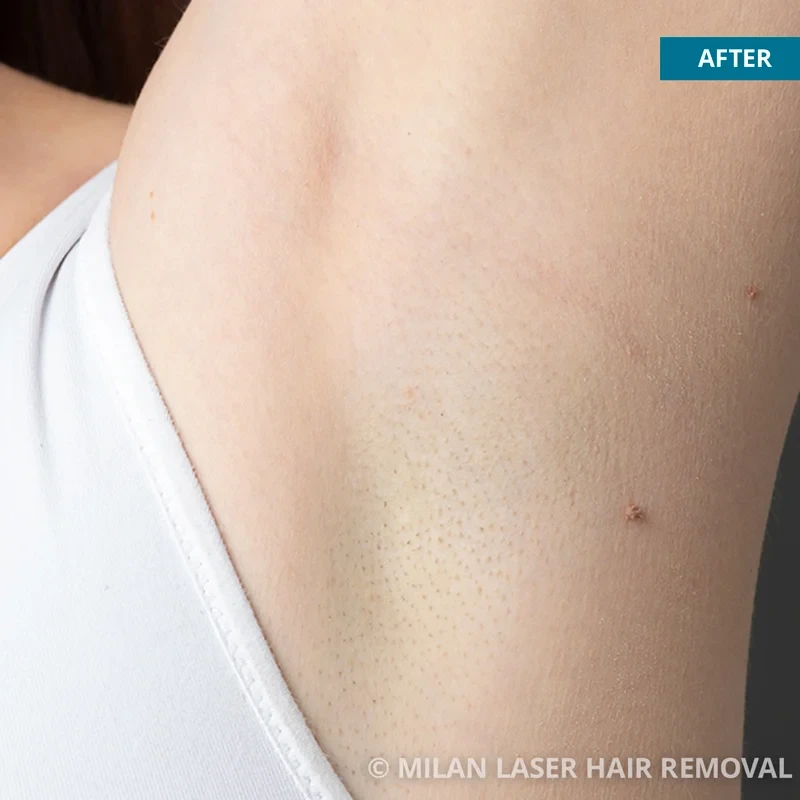 After photo of a underarm after getting our underarm laser hair removal treatment