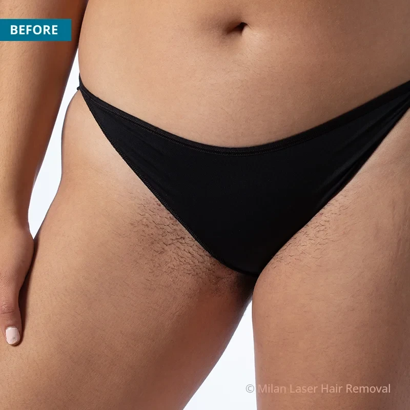 Before photo of a bikini prior to getting our bikini laser hair removal treatment