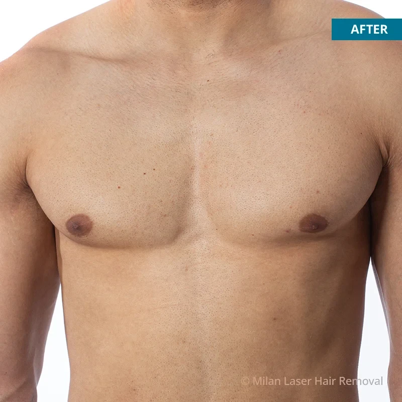 After photo of a men after getting our men laser hair removal treatment