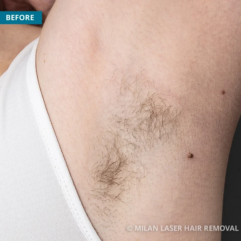 Before photo of a underarm prior to getting our underarm laser hair removal treatment