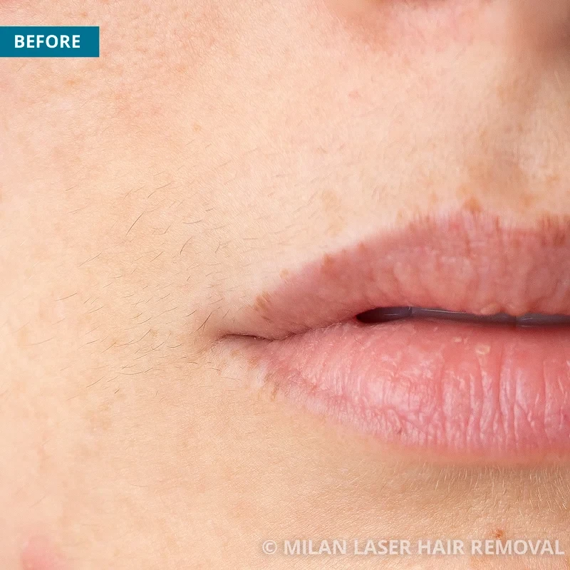 Before photo of a lip prior to getting our lip laser hair removal treatment