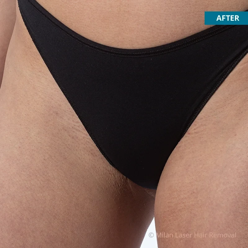 After photo of a bikini after getting our bikini laser hair removal treatment