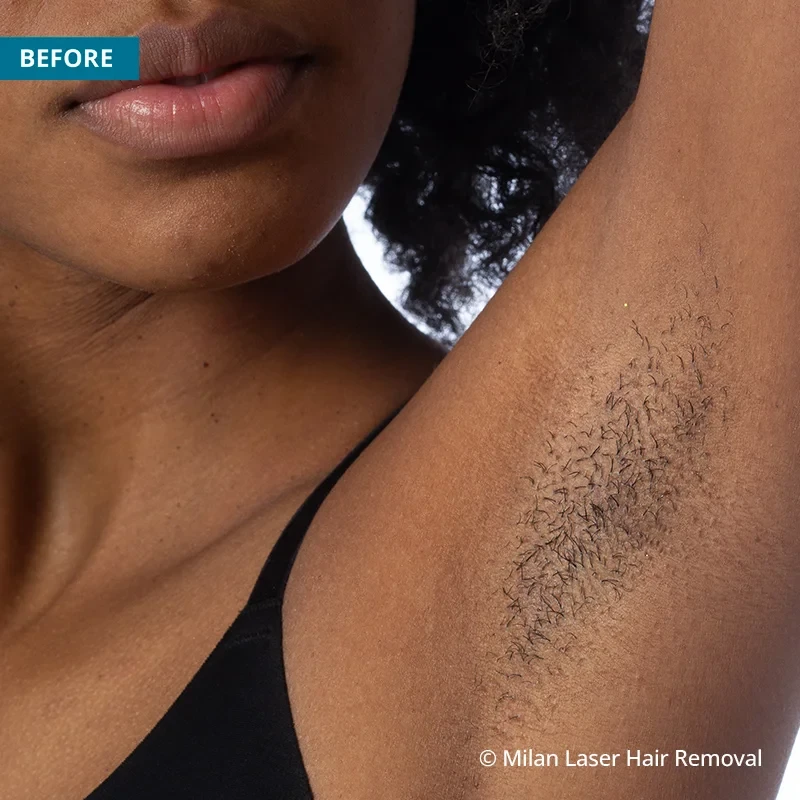 Before photo of a underarm prior to getting our underarm laser hair removal treatment