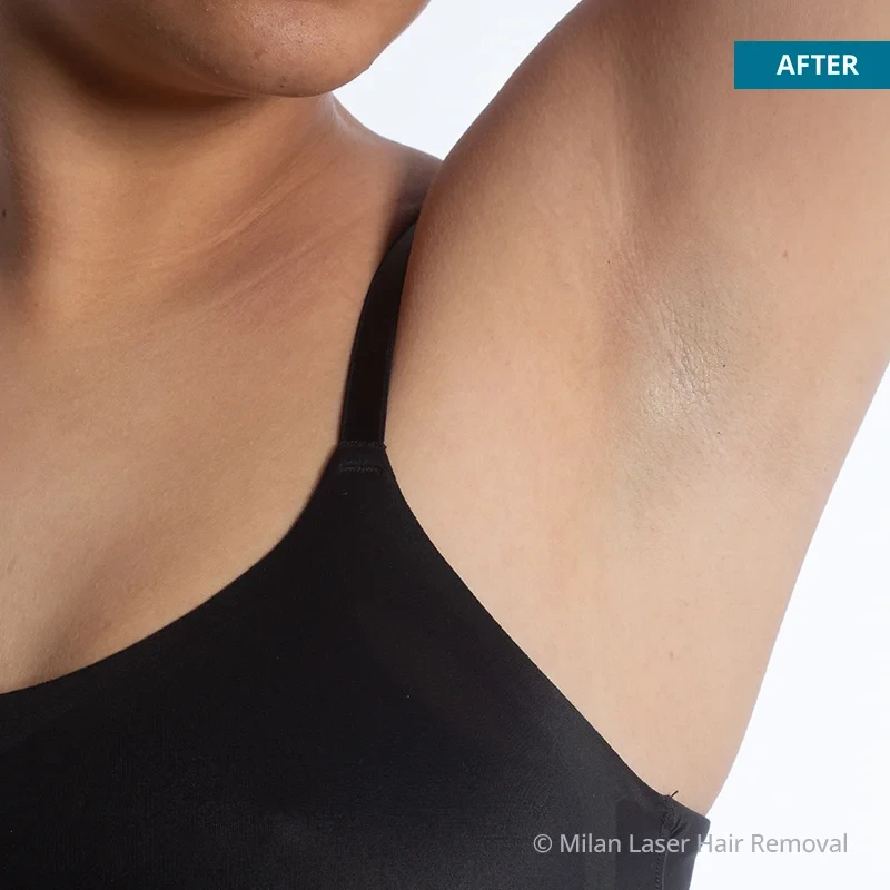 After photo of a underarm after getting our underarm laser hair removal treatment