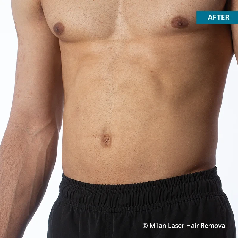 After photo of a men after getting our men laser hair removal treatment