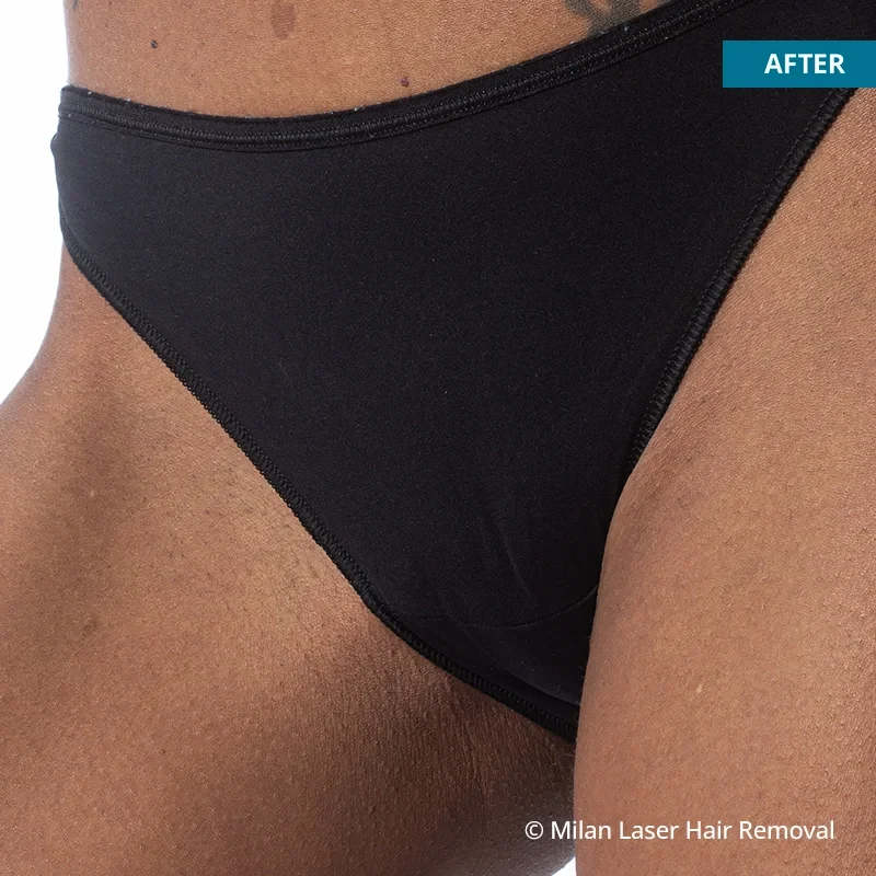 After photo of a bikini after getting our bikini laser hair removal treatment