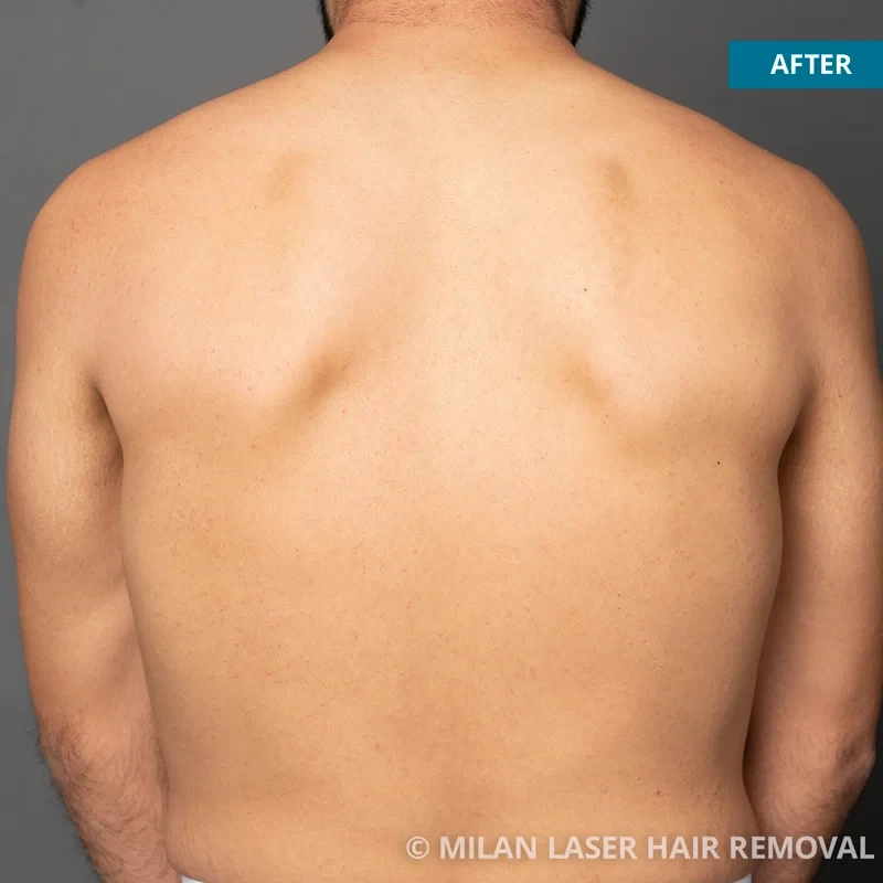 After photo of a men after getting our men laser hair removal treatment