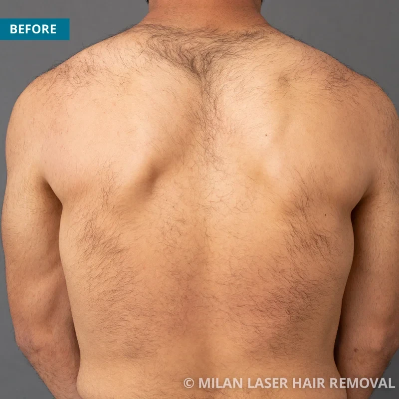 Before photo of a men prior to getting our men laser hair removal treatment