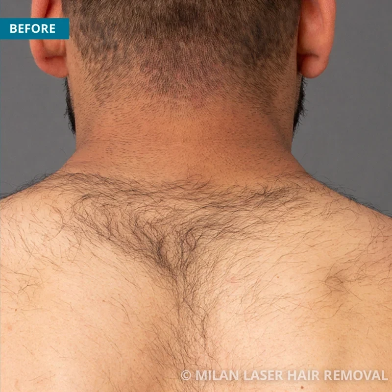 Before photo of a men prior to getting our men laser hair removal treatment