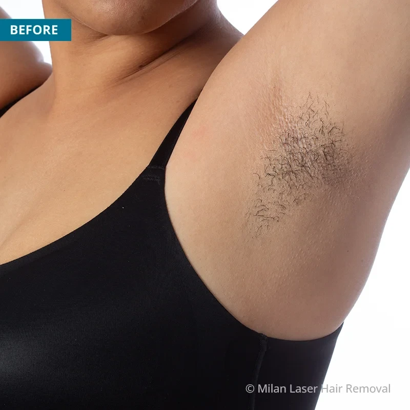 Before photo of a underarm prior to getting our underarm laser hair removal treatment