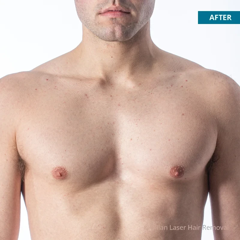 After photo of a men after getting our men laser hair removal treatment