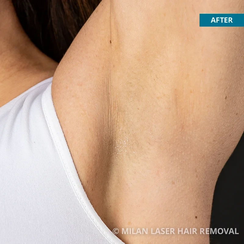 After photo of a underarm after getting our underarm laser hair removal treatment