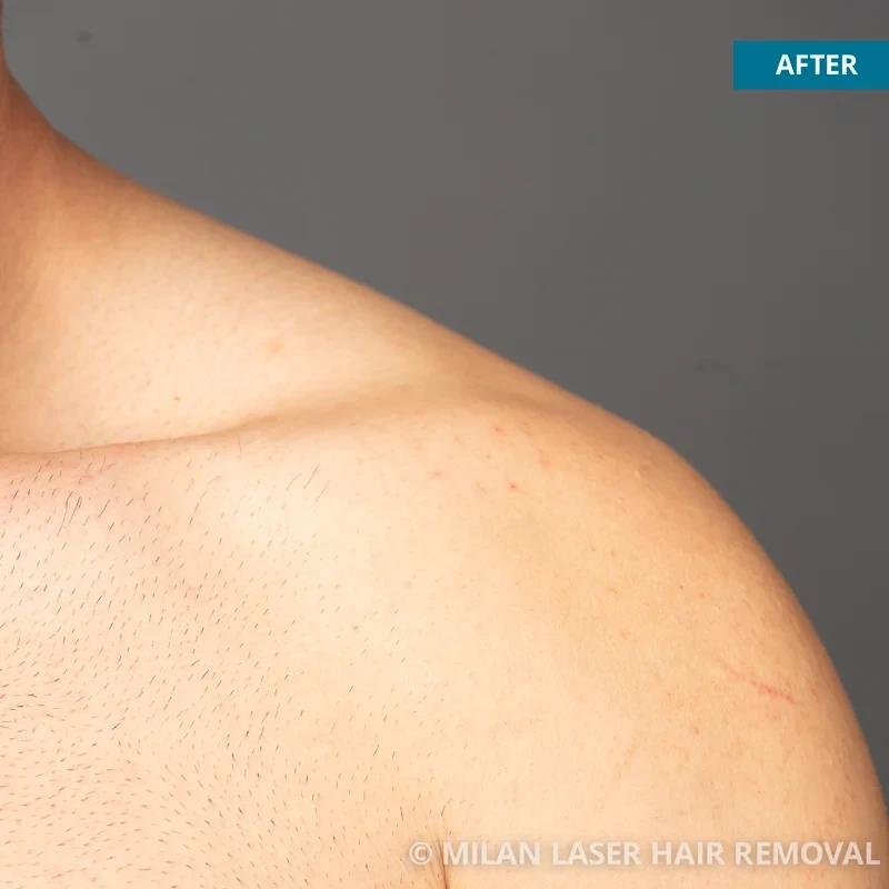 After photo of a men after getting our men laser hair removal treatment