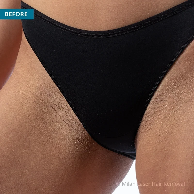 Before photo of a bikini prior to getting our bikini laser hair removal treatment