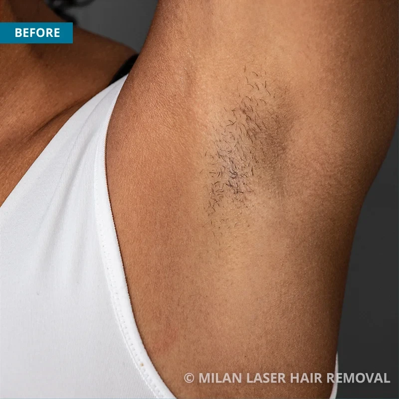 Before photo of a underarm prior to getting our underarm laser hair removal treatment