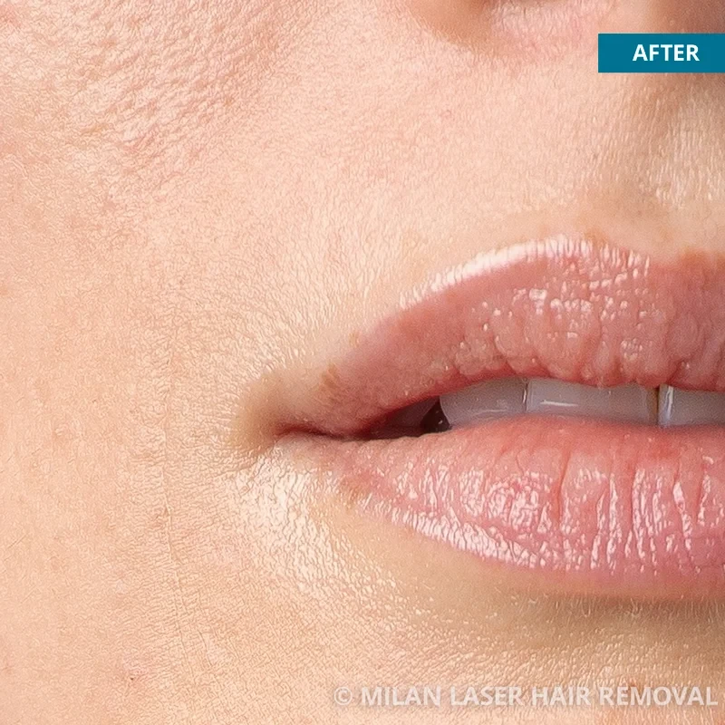 After photo of a lip after getting our lip laser hair removal treatment