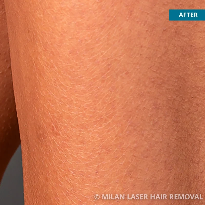 After photo of a legs after getting our legs laser hair removal treatment