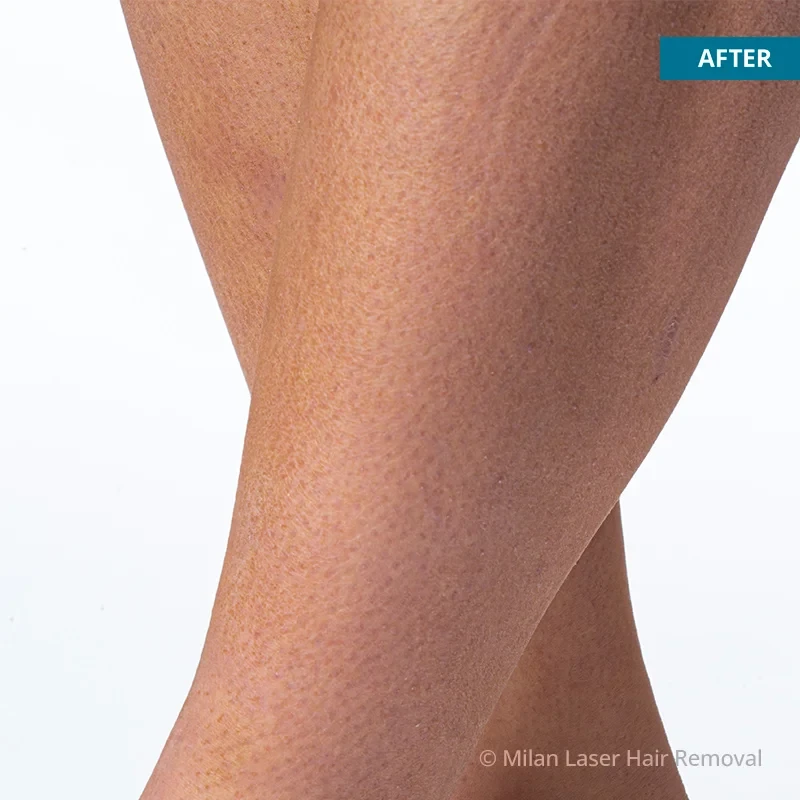 After photo of a legs after getting our legs laser hair removal treatment