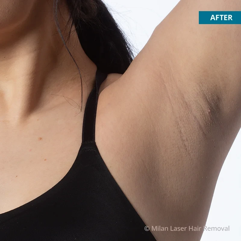 After photo of a underarm after getting our underarm laser hair removal treatment