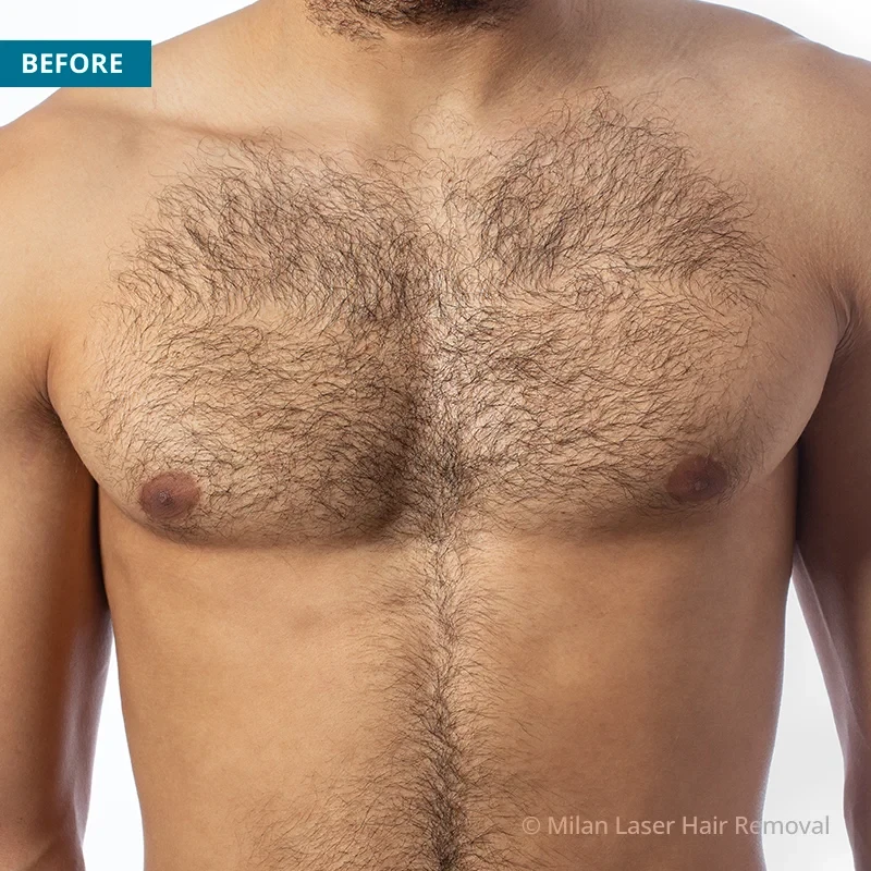 Before photo of a men prior to getting our men laser hair removal treatment