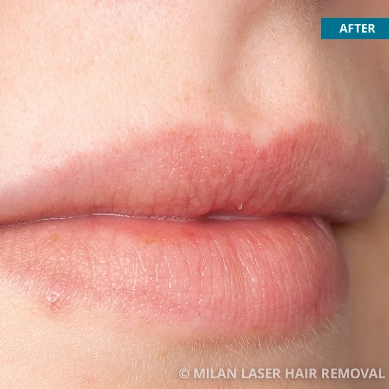 After photo of a lip after getting our lip laser hair removal treatment