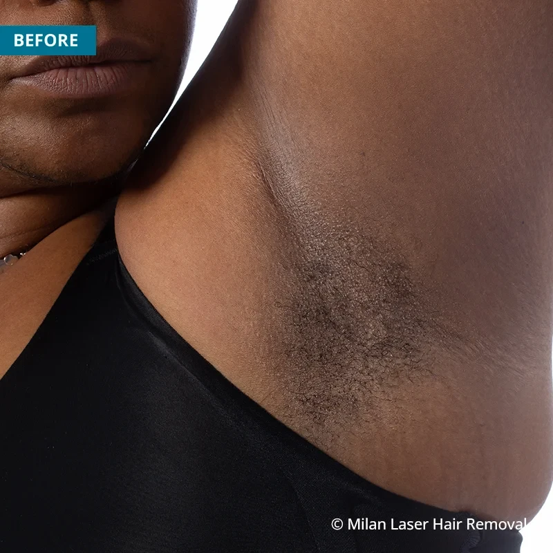 Before photo of a underarm prior to getting our underarm laser hair removal treatment