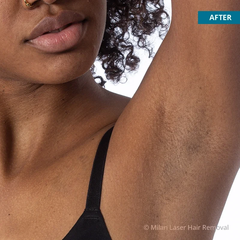 After photo of a underarm after getting our underarm laser hair removal treatment