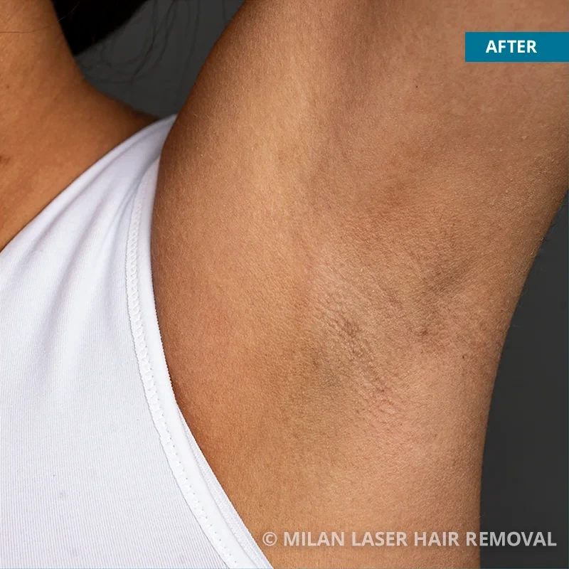 After photo of a underarm after getting our underarm laser hair removal treatment