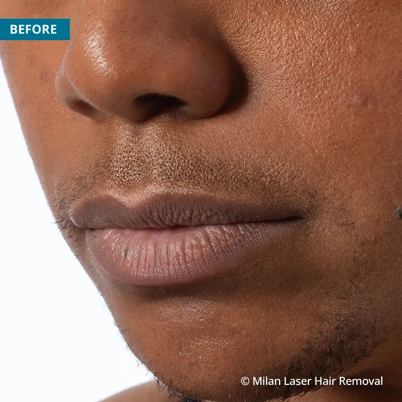 Before photo of a lip prior to getting our lip laser hair removal treatment