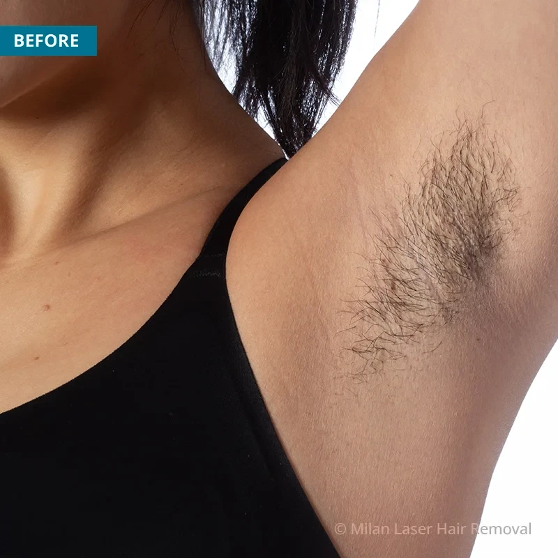 Before photo of a underarm prior to getting our underarm laser hair removal treatment